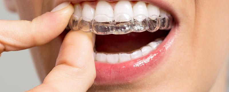 Benefits of Choosing Invisalign Over Traditional Braces in Balwyn